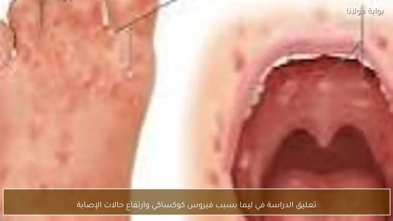 تعليق الدراسة في ليما بسبب فيروس كوكساكي وارتفاع حالات الإصابة