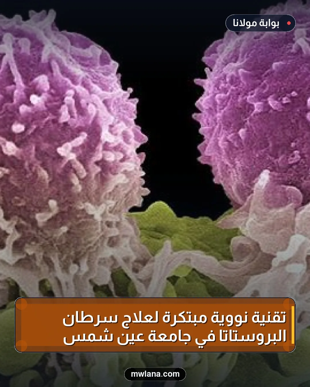 تقنية نووية مبتكرة لعلاج سرطان البروستاتا في جامعة عين شمس