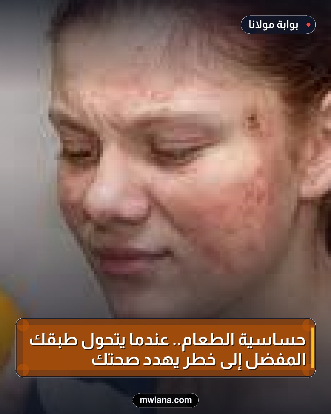 حساسية الطعام.. عندما يتحول طبقك المفضل إلى خطر يهدد صحتك