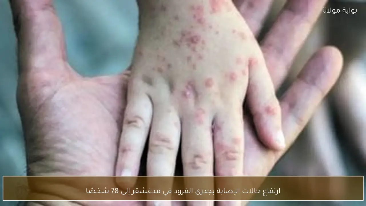 ارتفاع حالات الإصابة بجدرى القرود في مدغشقر إلى 78 شخصًا