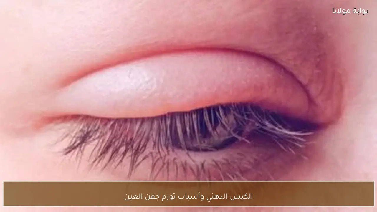 الكيس الدهني وأسباب تورم جفن العين