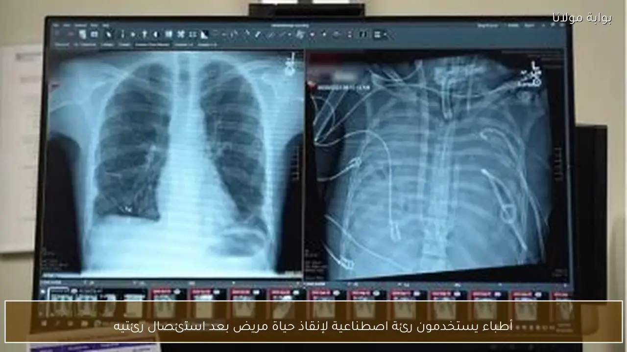 أطباء يستخدمون رئة اصطناعية لإنقاذ حياة مريض بعد استئصال رئتيه