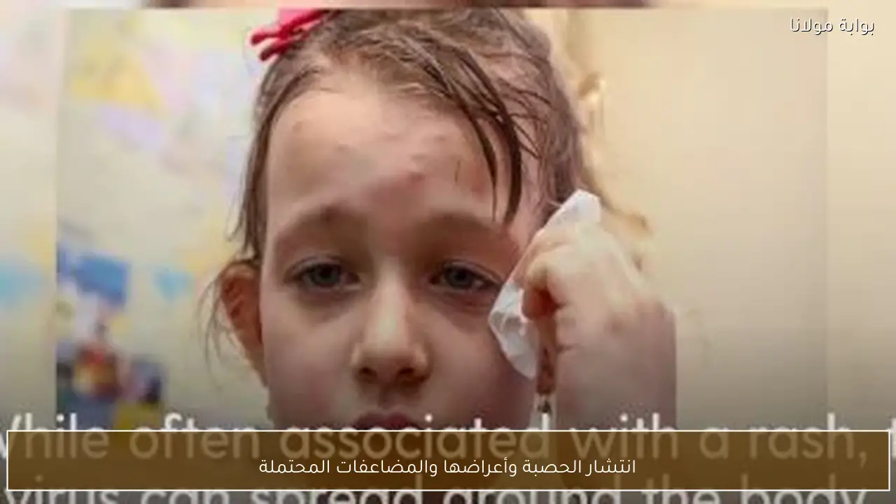 انتشار الحصبة وأعراضها والمضاعفات المحتملة