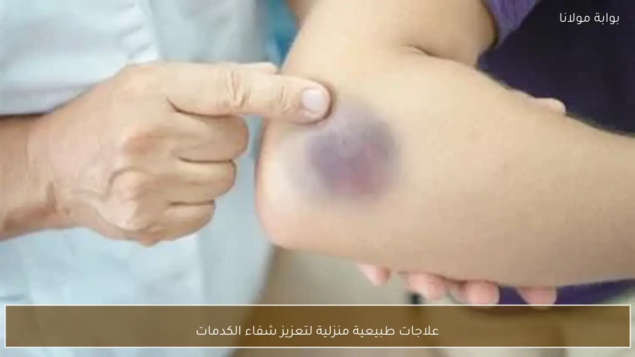 علاجات طبيعية منزلية لتعزيز شفاء الكدمات