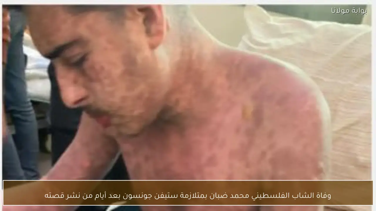 وفاة الشاب الفلسطيني محمد ضبان بمتلازمة ستيفن جونسون بعد أيام من نشر قصته