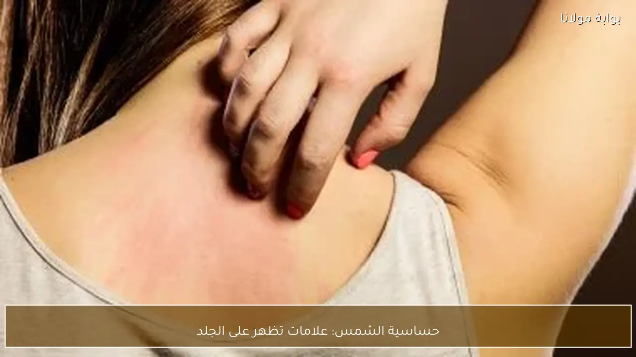 حساسية الشمس: علامات تظهر على الجلد