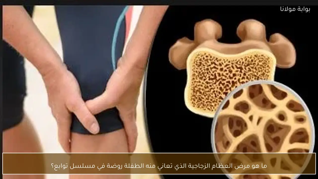 ما هو مرض العظام الزجاجية الذي تعاني منه الطفلة روضة في مسلسل توابع؟